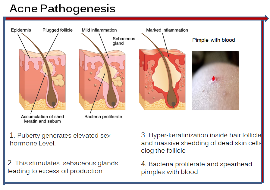 Pathogenesis-of-Acne
